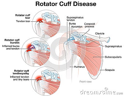 Shoulder Rotator Cuff Disease Illustration. Labeled Cartoon Illustration