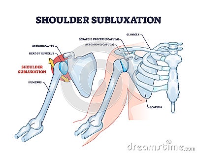 Shoulder subluxation as partial dislocated arm joint problem outline diagram Vector Illustration