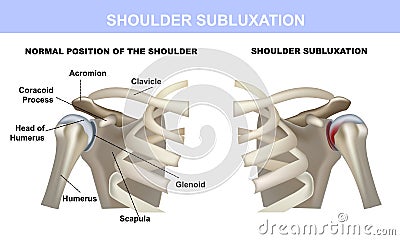 Shoulder subluxation, healthy shoulder joint and shoulder joint with subluxation, medical material with symbols Vector Illustration