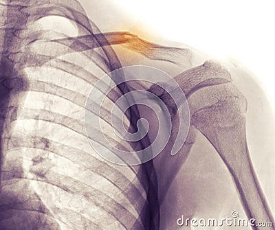 Shoulder x-ray, clavicle (collarbone) fracture Stock Photo