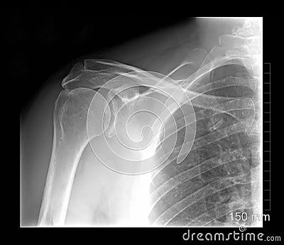 Shoulder xray Stock Photo