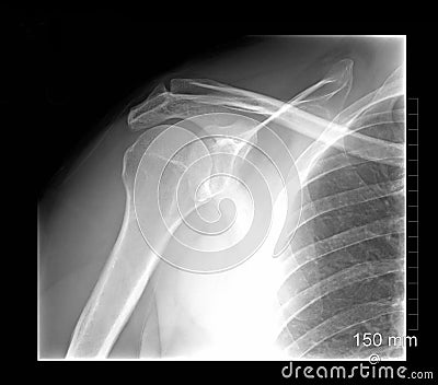 Shoulder xray Stock Photo