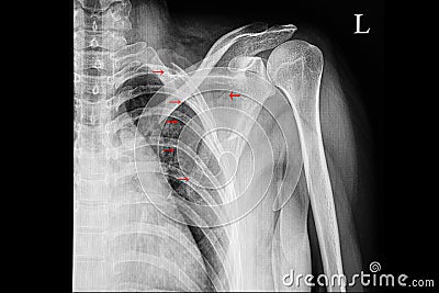 A shoulder xray film showing fractured second to to fifth ribs with fracture scapular blade Stock Photo