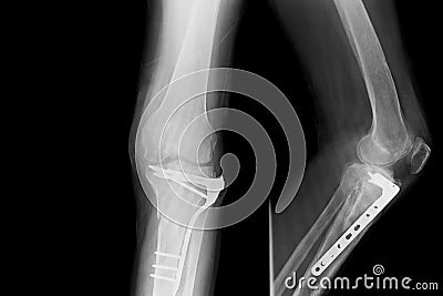 Show image of x-ray both leg and show external fixation of them Stock Photo
