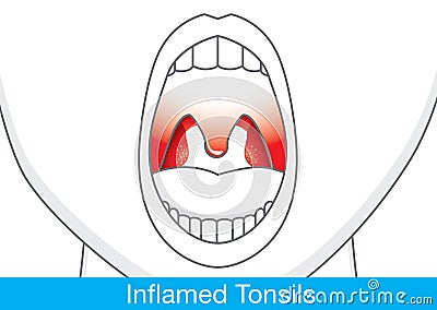 Showing Inflamed tonsils. Vector Illustration