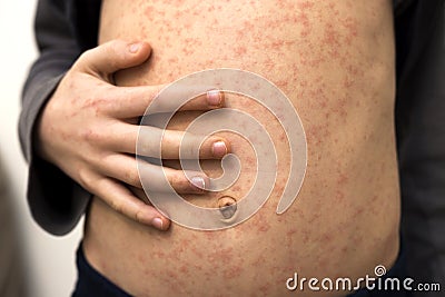 Sick child body, stomach with red rush spots from measles or chicken pox. Contagious child diseases and treatment Stock Photo