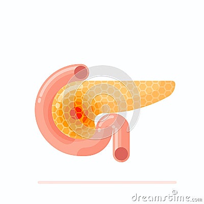 Sick human pancreas Vector Illustration
