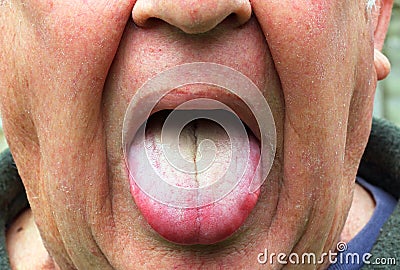 Sick or ill man, coated yellow tongue. Stock Photo