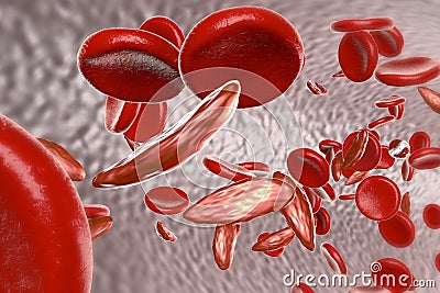 Sickle cell anemia Cartoon Illustration