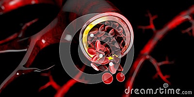 Sickle cell anemia, showing blood vessel with normal and deformated crescent, 3D illustration Cartoon Illustration