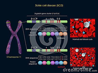 Sickle cell disease mutation Stock Photo