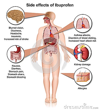 Side effects of ibuprofen 3d medical illustration on white background Vector Illustration