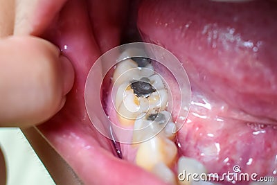 Silver amalgam fillings at right lower first molar and left lower second premolar teeth in Asian, young man. poor oral hygiene Stock Photo