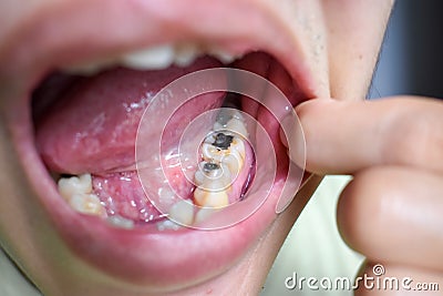 Silver amalgam fillings at right lower first molar and left lower second premolar teeth in Asian, young man. poor oral hygiene Stock Photo