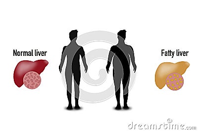 Normal liver and fatty liver, educational sheet Stock Photo