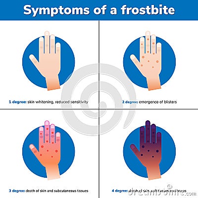 Simptoms of a frostbite. 4 medical stages. Infographic Cartoon Illustration