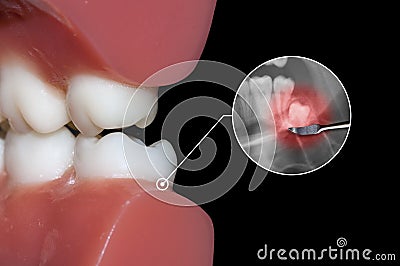 Simulation of wisdom tooth surgical extraction Stock Photo