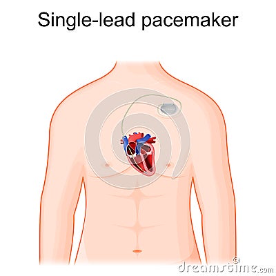 Single lead pacemaker placement. Cross section of heart and artificial cardiac pacemaker Vector Illustration