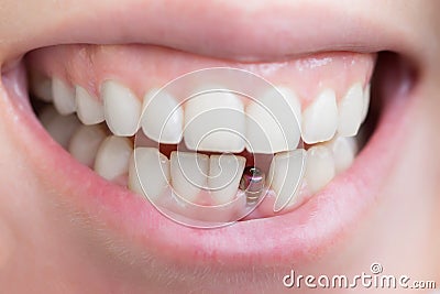 Single tooth implant Stock Photo