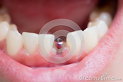 Single tooth implant Stock Photo