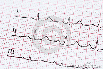 Sinus Heart Rhythm On Electrocardiogram Record Paper Showing Normal Heart Stock Photo