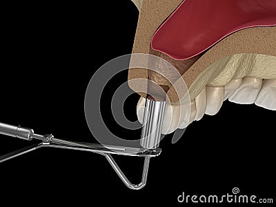 Sinus Lift Surgery - Adding new bone. illustration Cartoon Illustration