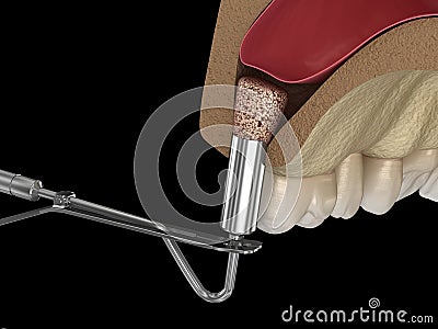 Sinus Lift Surgery - Adding new bone. illustration Cartoon Illustration