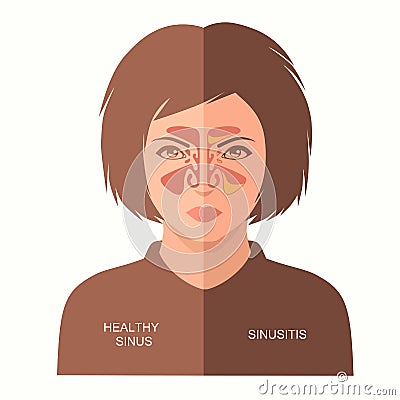 Sinusitis disease, Vector Illustration