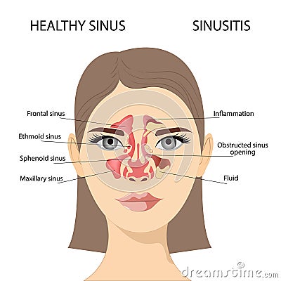 Sinusitis, Female face with inflammation of the mucous membrane of the paranasal and frontal sinuses. Vector Illustration