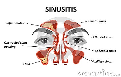 Sinusitis. Vector Illustration