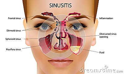 Sinusitis. Healthy and inflammation nasal sinus vector illustration Vector Illustration