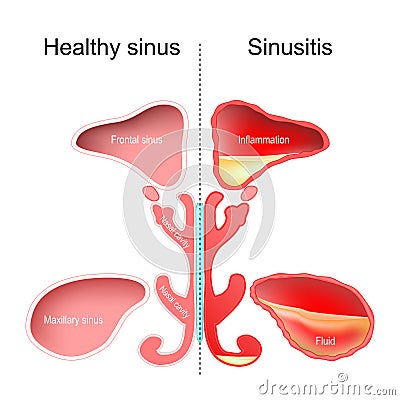 Sinusitis. Healthy nasal sinus and sinus with infection Vector Illustration