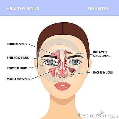 Sinusitis. Healthy and sinus infections, signs, realistic illustration for medical posters and educational materials Vector Illustration