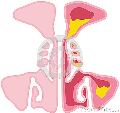 Sinusitis, vector illustration, labeled Cartoon Illustration