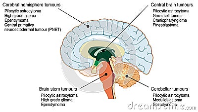 Sites of various brain tumours Vector Illustration
