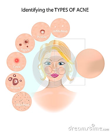 The six types of acne infographic Vector Illustration