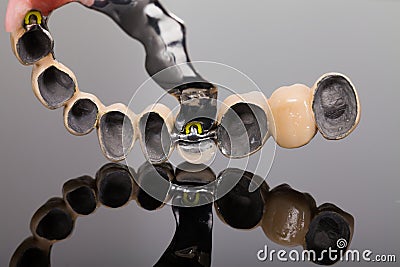 Skeletal prosthesis - art of dentsitry Stock Photo