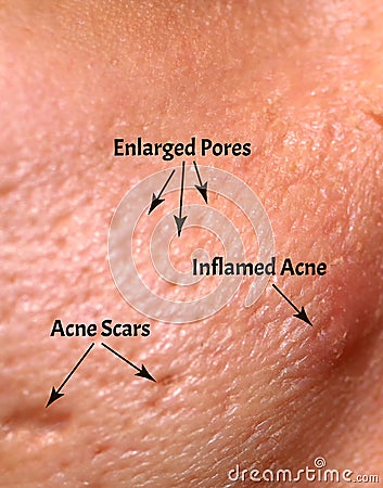 Skin with acne, acne scars, enlarged pores. Stock Photo