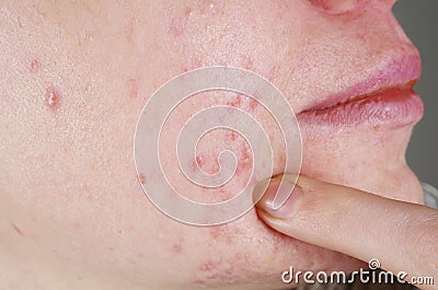 Skin with acne problems Stock Photo