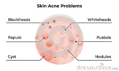 Skin acne types diagram. Vector skin problems disease, pimples blackheads and comedones, cosmetology skincare treatment Vector Illustration