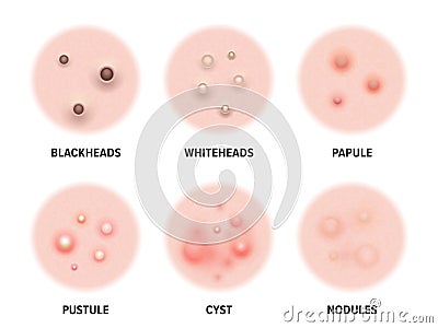 Skin acne types diagram. Vector skin disease pimples blackheads and comedones, cosmetology and skincare problems treatment Vector Illustration