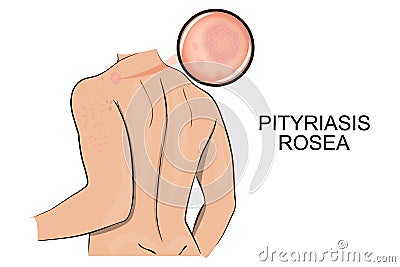 The skin affected by ringworm pink. pityriasis rosea. Vector Illustration