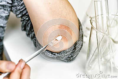 Skin allergy diseases problem, Close up of doctor doing treatment on atopic dermatitis rash. Stock Photo