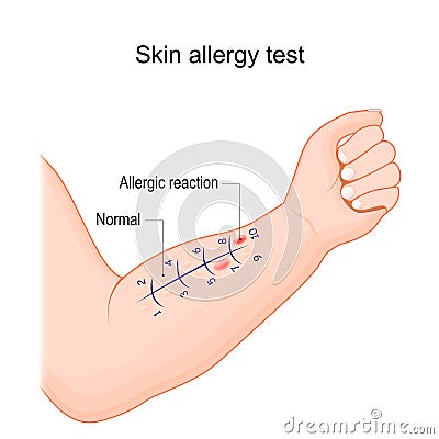 Skin allergy test. Human arm with allergen Vector Illustration