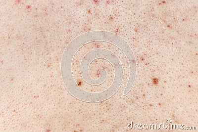 Skin background texture with pimples and blackheads. problematic skin close up. acne diseases Stock Photo