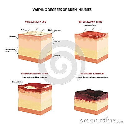 Skin burn classification. Vector Illustration