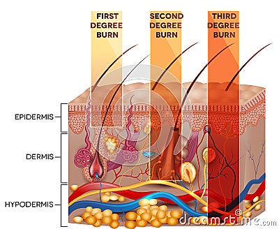 Skin burn classification Vector Illustration