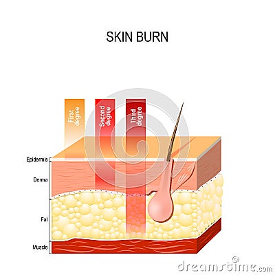 Skin burn. Three degrees of burns. Vector Illustration