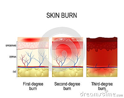 Skin burn. Three degrees of burns. Vector Illustration