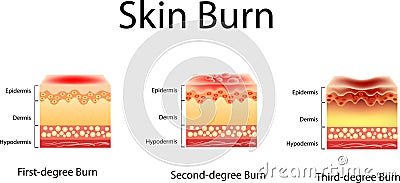 Skin burn. Three degrees of burns. type of injury to skin, Vector illustration Vector Illustration